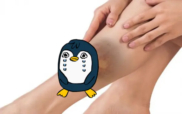 Tips for treating bruises from falling off a bike